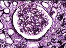 GLOMERULONEP-HRITIS