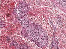 LEPROMATOUS LEPROSY