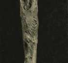 Osteomyelitis