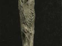 Osteomyelitis