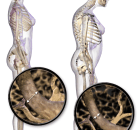 Osteoporosis