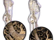Osteoporosis