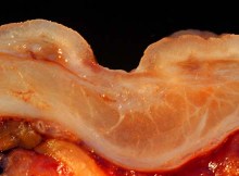 PEPTIC-ULCERS