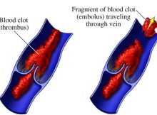 thrombosis-embolism