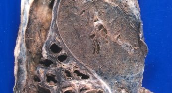 BRONCHIECTASIS