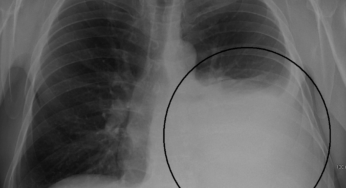 PLEURAL EFFUSIONS