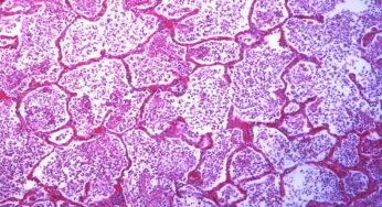 Pneumonia