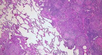 PULMONARY TUBERCULOSIS