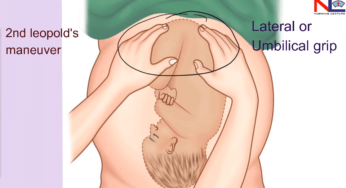 Leopold’s Maneuvers (Obstetric Grips)
